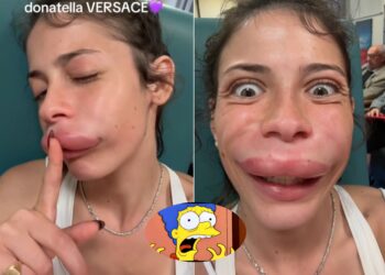 Botox cât încape! Ultima fiță printre tinere: look-ul Marge Simpson!